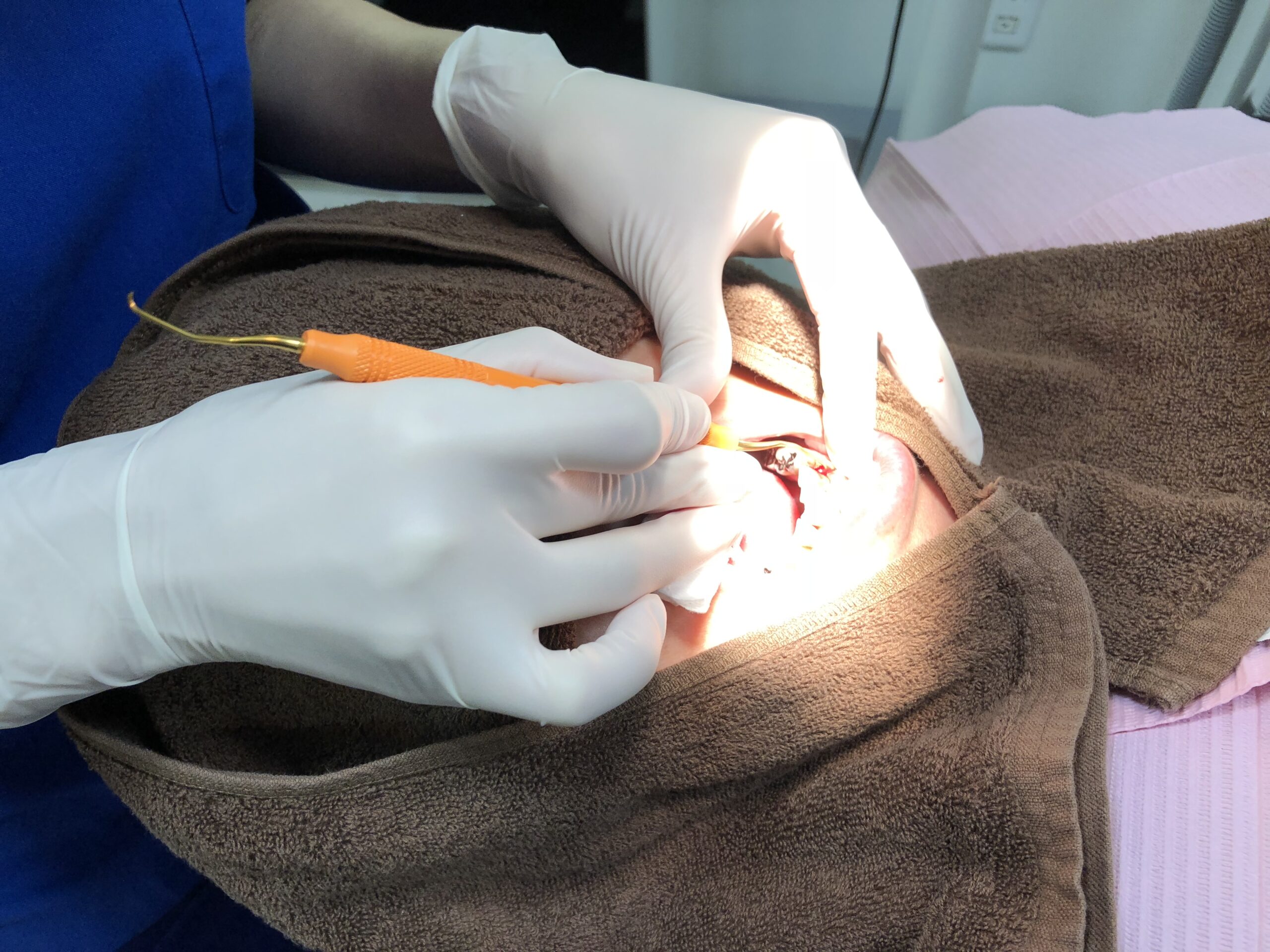 重度の歯周病とは?  本当に歯周外科治療が必要ですか?